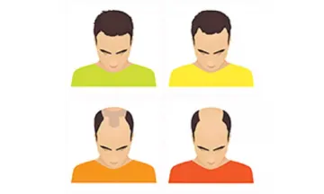 The best ways to combat a receding hairline