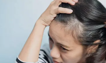 Can alopecia areata affect women?