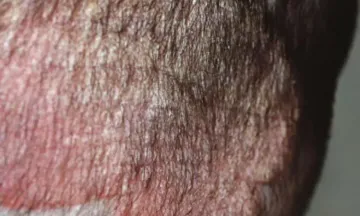 Home remedies for Scalp Psoriasis | Dr Batra's™ Home remedies for Scalp Psoriasis | Dr Batra's™