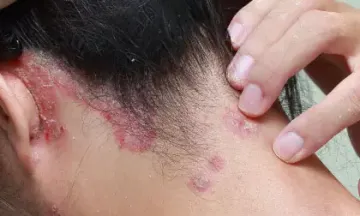 Can homeopathy treatment help scalp psoriasis?