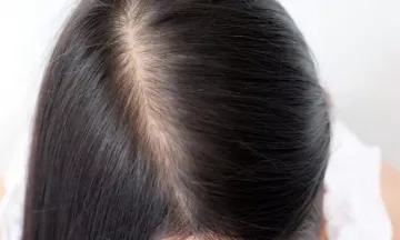 Battle Female Pattern Baldness with Homeopathy