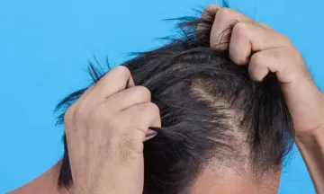 BrainPower Neurodevelopmental Center - “Trichotillomania  (trik-o-til-o-MAY-nee-uh), also called hair-pulling disorder, is a mental  disorder that involves recurrent, irresistible urges to pull out hair from  your scalp, eyebrows or other areas of your