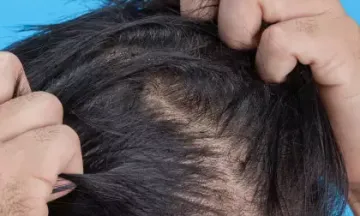 Hair pulling disorder: Causes & Treatments