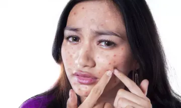 Clear acne with homeopathy