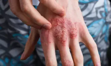 Eczema triggers and how to avoid them?