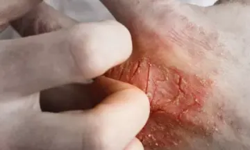 Eczema and stress: What's the connection?