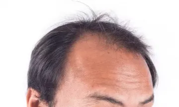 Best 15 SelfHelp Tips for Male Pattern Baldness  Dr Batras