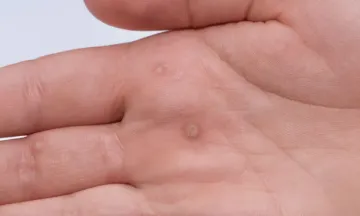 Reasons to treat warts with homeopathy