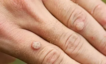 Get rid of warts with homeopathy