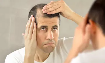 3 things you should know about male pattern baldness 