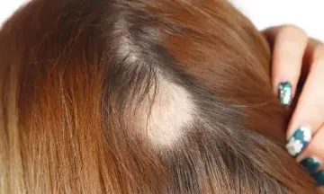 Know what it's like to have alopecia
