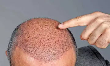 Mumbai man dies after hair transplant 9 months on family seeks action  against dermatologist  Mumbai News The Indian Express