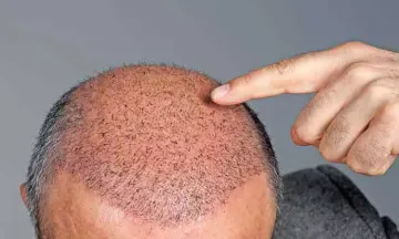 Losing Hair after Hair Transplant