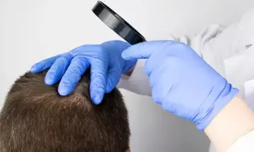 5 Helpful Tips to Manage Alopecia Areata