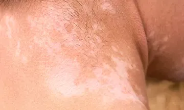 5 ways to stop vitiligo from spreading