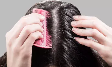 5 myths of dandruff busted