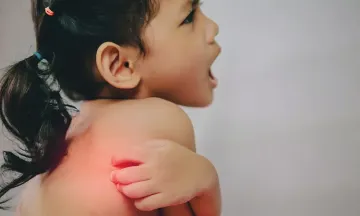 5 things that may make eczema worse