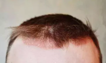 What I Wish Everyone Knew About Scalp Psoriasis And Homeopathy.