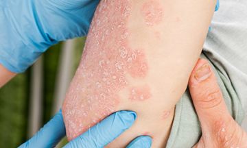 7 reasons why homeopathy is better than psoriasis creams