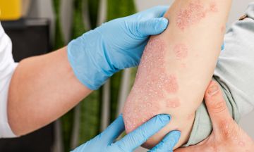 7 reasons why homeopathy is better than psoriasis creams