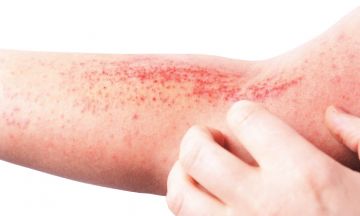 How to know if you have atopic eczema?