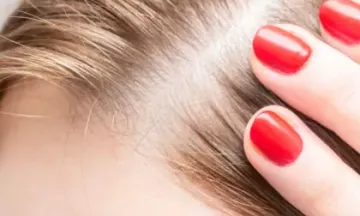 What causes baldness in women?