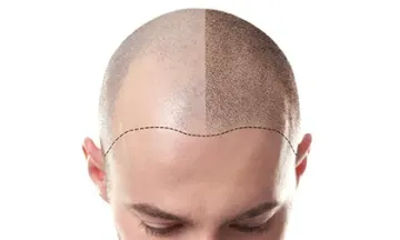 Homeopathy treats hair loss in men safely
