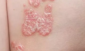 How can I stop psoriasis from spreading?