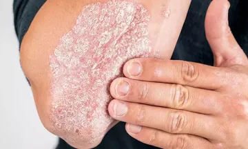 How Psoriasis can be treated by Homeopathy