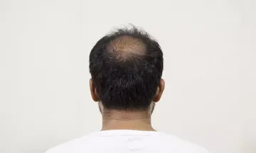 How do you know if you'll go bald?