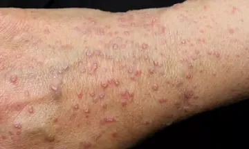 How long does lichen planus take to clear up?