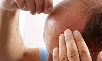 Is being bald making you depressed? Visit nearest homeopathic clinic