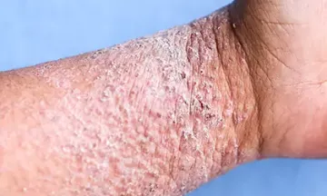 Is eczema inflammatory?