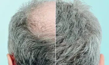 Is hair regrowth possible with homeopathy?