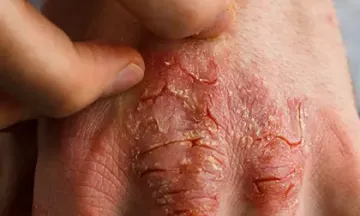 Is it good to exfoliate eczema skin?