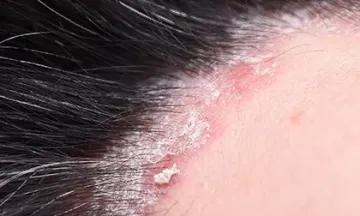 Is there a treatment for scalp psoriasis?