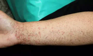 Lichen planus treatment in homeopathy