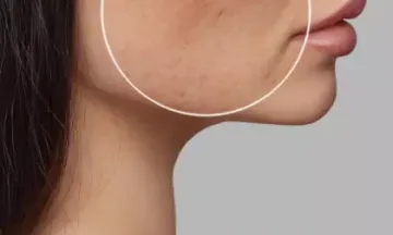 What are the characteristics of acne?