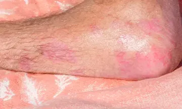 Psoriasis gets worse in summer?