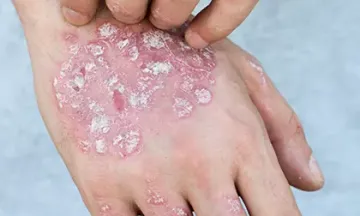 Psoriasis on hands: Causes & treatment