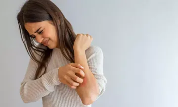 Psychological Factors Too May Worsen Your Eczema!