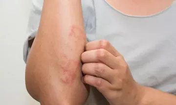 Psychological impact due to eczema