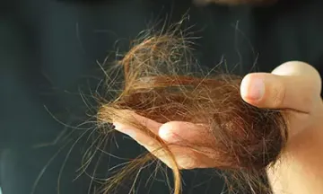 Reasons why homeopathy is best for hair fall treatment