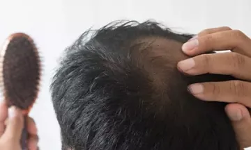 Reasons for hair fall in men