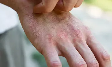 Risk factors for developing eczema
