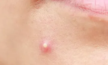 Skin care tips to get rid of pimples