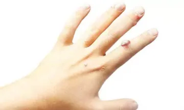 Things Nobody Told You about Warts and Homeopathy