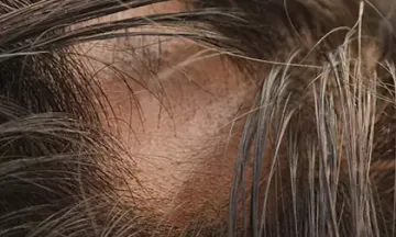 Things to know about Alopecia Areata