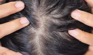 Solution for baldness in women
