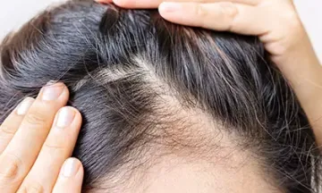 Treatment options for female pattern baldness